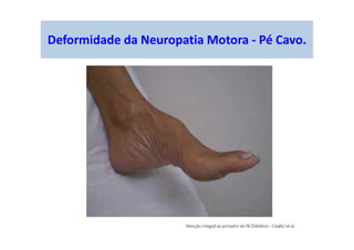 Deformidade da Neuropatia Motora - Pé Cavo.
 