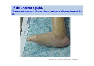 Pé de Charcot agudo.
Observar o desabamento do arco plantar, o edema e a hiperemia do médio-
pé.
 
