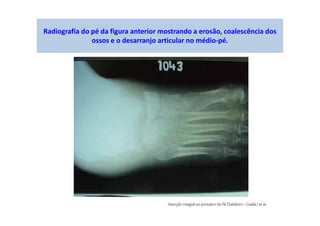 Radiografia do pé da figura anterior mostrando a erosão, coalescência dos
ossos e o desarranjo articular no médio-pé.
 