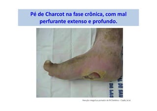 Pé de Charcot na fase crônica, com mal
perfurante extenso e profundo.
 