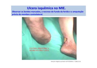 Ulcera isquêmica no MIE.
Observar os bordos marcados, a necrose do fundo da ferida e a amputação
prévia do membro contralateral.
 