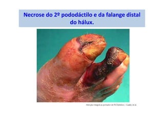 Necrose do 2º pododáctilo e da falange distal
do hálux.
 