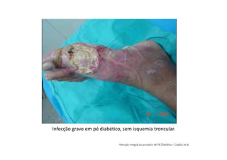Infecção grave em pé diabético, sem isquemia troncular.
 