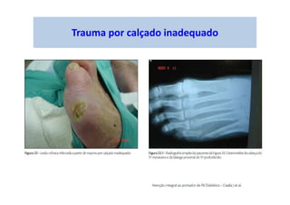 Trauma por calçado inadequado
 