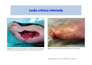Lesão crônica infectada
 