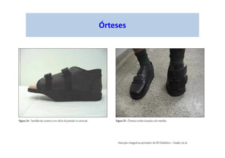 Órteses
 