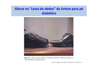 Altura na “caixa de dedos” da órtese para pé
diabético
 