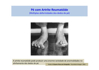 Pé com Artrite Reumatóide
(Múltiplas deformidades dos dedos do pé)
A artrite reumatóide pode produzir uma enorme variedade de anormalidades no
alinhamento dos dedos do pé. Reider, O Exame Físico em Ortopedia – Guanabara Koogan -2001
 