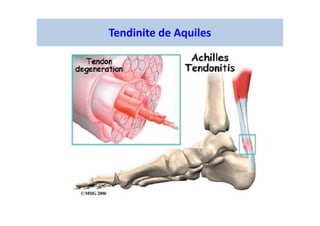 Tendinite de Aquiles
 
