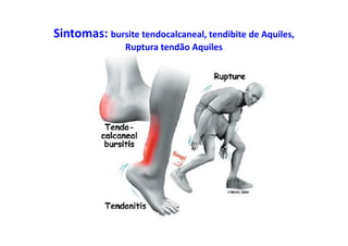 Sintomas: bursite tendocalcaneal, tendibite de Aquiles,
Ruptura tendão Aquiles
 
