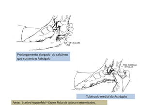 Prolongamento alargado do calcâneo
que sustenta o Astrágalo
Tubérculo medial do Astrágalo
Fonte: Stanley Hoppenfeld – Exame Físico da coluna e extremidades.
 