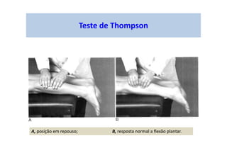 Teste de Thompson
A, posição em repouso; B, resposta normal a flexão plantar.
 