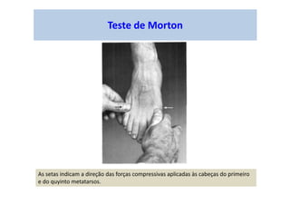Teste de Morton
As setas indicam a direção das forças compressivas aplicadas às cabeças do primeiro
e do quyinto metatarsos.
 