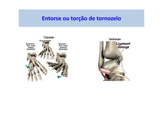 Entorse ou torção de tornozelo
 