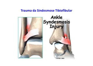 figura
Trauma da Sindesmose Tibiofibular
 