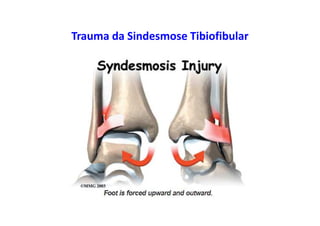 Trauma da Sindesmose Tibiofibular
 