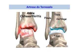 Artrose do Tornozelo
 