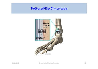 10/12/2015 Dr. José Heitor Machado Fernandes 243
Prótese Não Cimentada
 