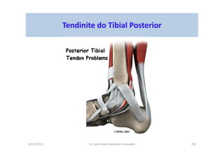 10/12/2015 Dr. José Heitor Machado Fernandes 252
Tendinite do Tibial Posterior
 