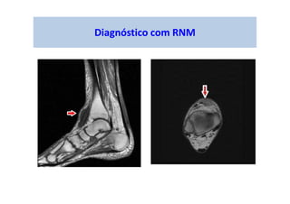 Diagnóstico com RNM
 