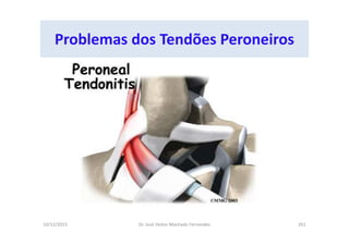 10/12/2015 Dr. José Heitor Machado Fernandes 261
Problemas dos Tendões Peroneiros
 