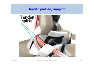 10/12/2015 Dr. José Heitor Machado Fernandes 263
Tendão partido, rompido
 