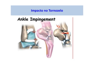 Impacto no Tornozelo
 