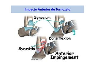 Impacto Anterior de Tornozelo
 