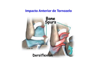 Impacto Anterior de Tornozelo
 
