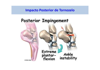 Impacto Posterior de Tornozelo
 