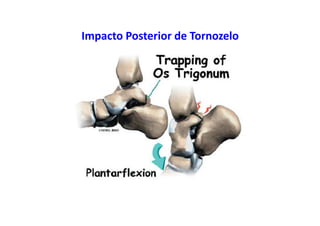 Impacto Posterior de Tornozelo
 