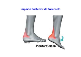 Impacto Posterior de Tornozelo
 