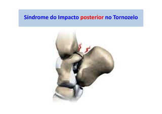 Síndrome do Impacto posterior no Tornozelo
 