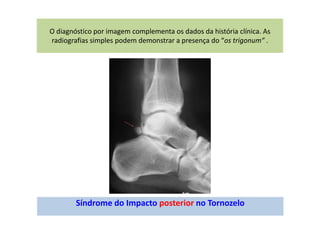 O diagnóstico por imagem complementa os dados da história clínica. As
radiografias simples podem demonstrar a presença do “os trigonum” .
Síndrome do Impacto posterior no Tornozelo
 