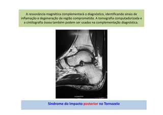 A ressonância magnética complementará o diagnóstico, identificando sinais de
inflamação e degeneração da região comprometida. A tomografia computadorizada e
a cintilografia óssea também podem ser usadas na complementação diagnóstica.
Síndrome do Impacto posterior no Tornozelo
 