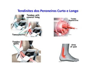 Tendinites dos Peroneiros Curto e Longo
 