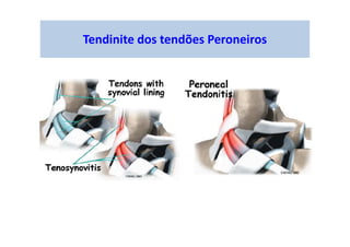 Tendinite dos tendões Peroneiros
 