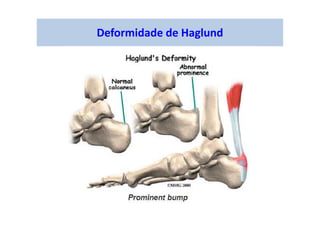 Deformidade de Haglund
 