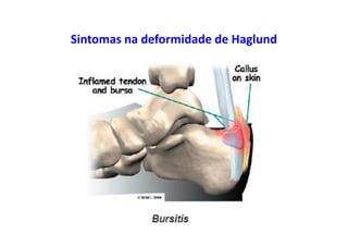 Sintomas na deformidade de Haglund
 