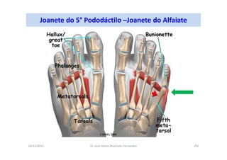 10/12/2015 Dr. José Heitor Machado Fernandes 292
Joanete do 5° Pododáctilo –Joanete do Alfaiate
 