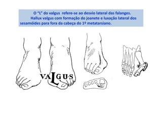 O “L” do valgus refere-se ao desvio lateral das falanges.
Hallux valgus com formação do joanete e luxação lateral dos
sesamóides para fora da cabeça do 1º metatarsiano.
 