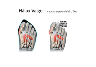 Hálux Valgo – causas: sapato de bico fino
 