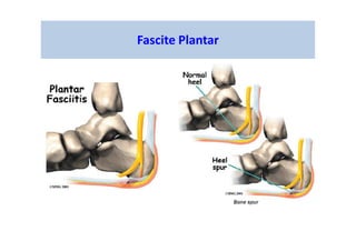 Fascite Plantar
 