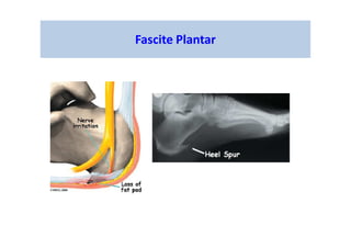 Fascite Plantar
 