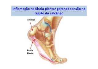 Inflamação na fáscia plantar gerando tensão na
região do calcâneo
 
