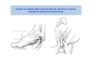 Esporão de calcâneo afeta a fase de apoio do calcanhar na marcha.
Palpação da aponeurose plantar do pé.
 