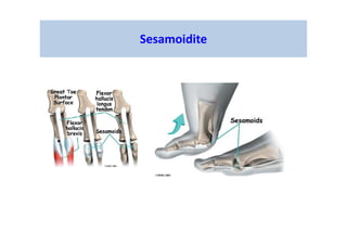 Sesamoidite
 
