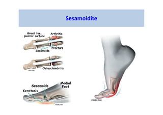 Sesamoidite
 