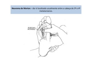 Neuroma de Morton – dor é localizada usualmente entre a cabeça do 3º e 4º
metatarsianos.
 