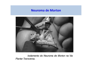 Neuroma de Morton
 